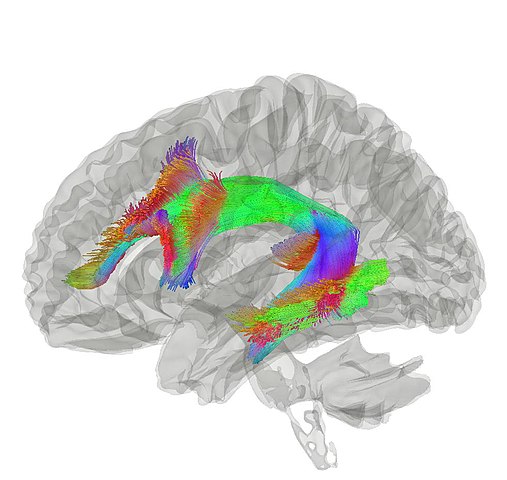 Tractography showing the arcuate fascilicus
